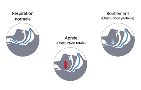 Troubles respiratoires et du sommeil