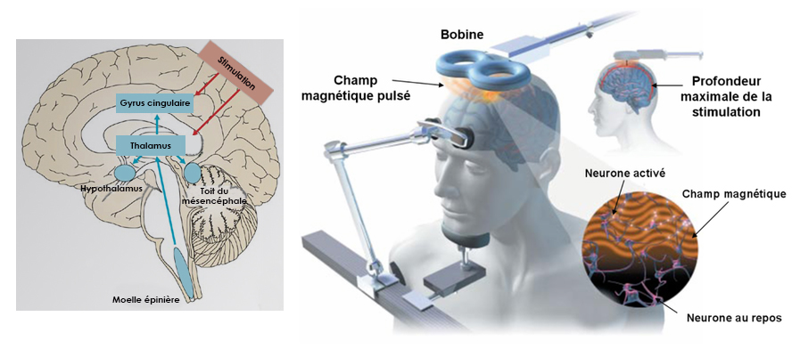 Stimulation magnétique transcrânienne